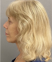 Neck Lift After Photo by Keshav Magge, MD; Bethesda, MD - Case 47817