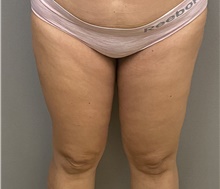 Liposuction After Photo by Keshav Magge, MD; Bethesda, MD - Case 48015