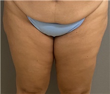 Liposuction Before Photo by Keshav Magge, MD; Bethesda, MD - Case 48015