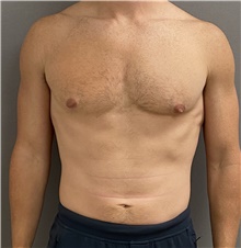 Male Breast Reduction Before Photo by Keshav Magge, MD; Bethesda, MD - Case 48016