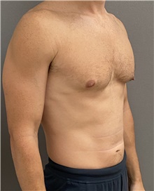 Male Breast Reduction Before Photo by Keshav Magge, MD; Bethesda, MD - Case 48016