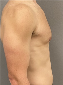 Male Breast Reduction After Photo by Keshav Magge, MD; Bethesda, MD - Case 48016