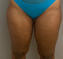 Liposuction After Photo by Keshav Magge, MD; Bethesda, MD - Case 48017