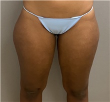 Liposuction Before Photo by Keshav Magge, MD; Bethesda, MD - Case 48017