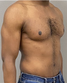 Male Breast Reduction After Photo by Keshav Magge, MD; Bethesda, MD - Case 48018