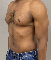 Male Breast Reduction After Photo by Keshav Magge, MD; Bethesda, MD - Case 48018