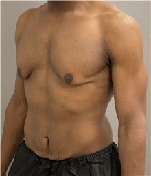 Male Breast Reduction Before Photo by Keshav Magge, MD; Bethesda, MD - Case 48018