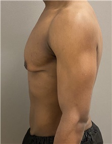 Male Breast Reduction Before Photo by Keshav Magge, MD; Bethesda, MD - Case 48018
