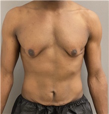 Tummy Tuck Before Photo by Keshav Magge, MD; Bethesda, MD - Case 48019