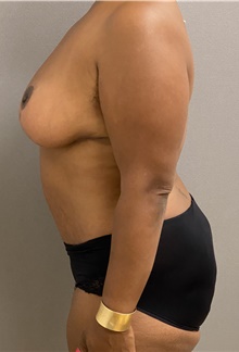 Breast Reduction After Photo by Keshav Magge, MD; Bethesda, MD - Case 48020