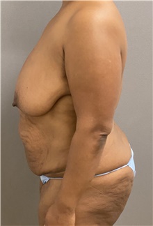 Breast Reduction Before Photo by Keshav Magge, MD; Bethesda, MD - Case 48020