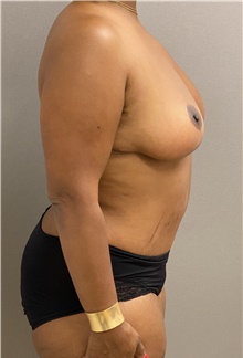 Breast Reduction After Photo by Keshav Magge, MD; Bethesda, MD - Case 48020