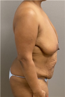 Breast Reduction Before Photo by Keshav Magge, MD; Bethesda, MD - Case 48020