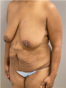 Tummy Tuck Before Photo by Keshav Magge, MD; Bethesda, MD - Case 48021