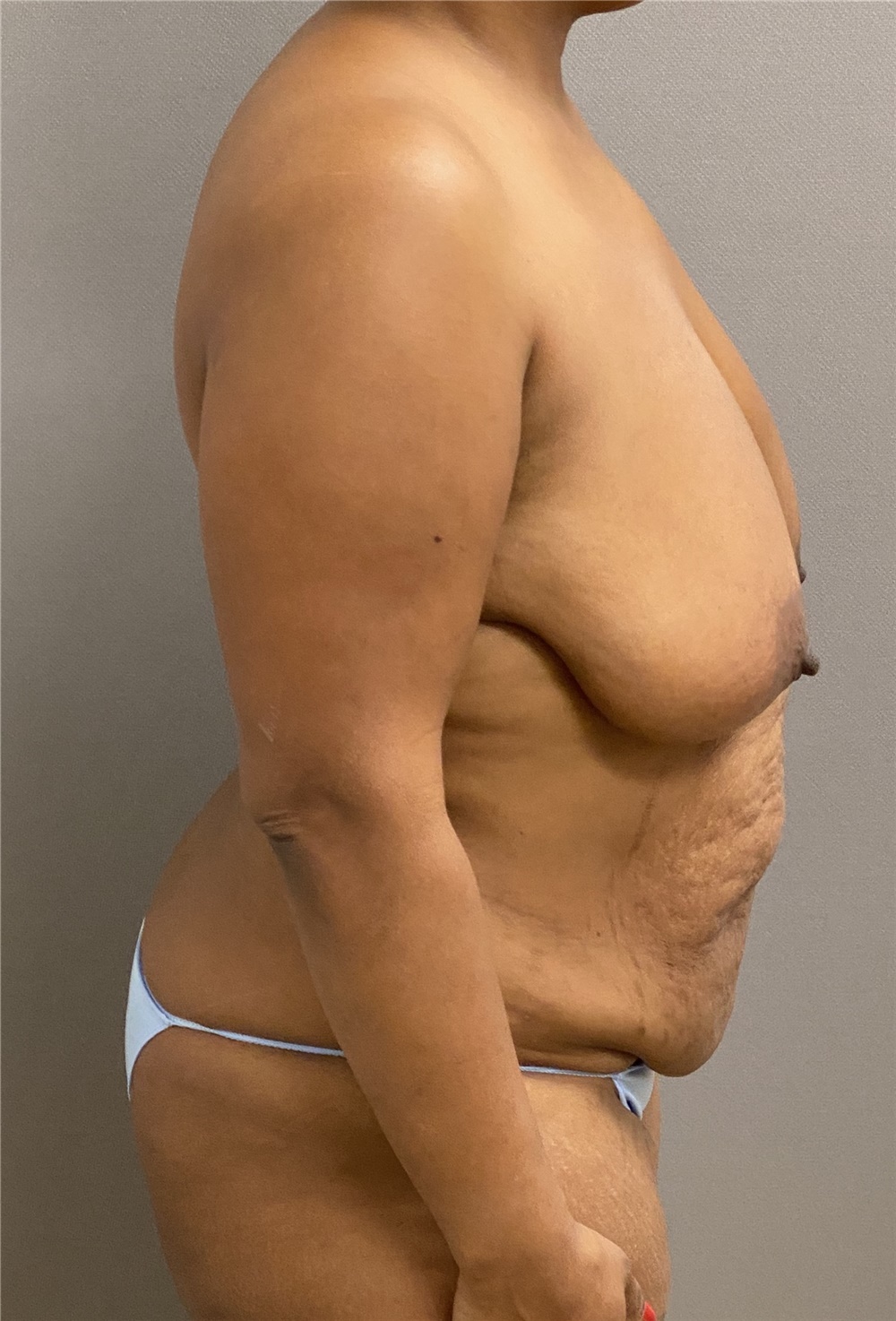 Body Contouring Before and After Photos by Keshav Magge, MD; Bethesda, MD -  Case 38640