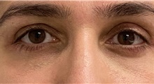 Eyelid Surgery After Photo by Keshav Magge, MD; Bethesda, MD - Case 48023