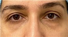 Eyelid Surgery Before Photo by Keshav Magge, MD; Bethesda, MD - Case 48023