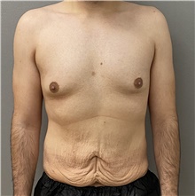 Male Breast Reduction Before Photo by Keshav Magge, MD; Bethesda, MD - Case 48024