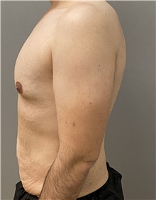 Male Breast Reduction Before Photo by Keshav Magge, MD; Bethesda, MD - Case 48024