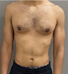 Male Breast Reduction After Photo by Keshav Magge, MD; Bethesda, MD - Case 48026