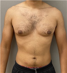 Male Breast Reduction Before Photo by Keshav Magge, MD; Bethesda, MD - Case 48026