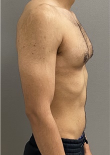 Male Breast Reduction After Photo by Keshav Magge, MD; Bethesda, MD - Case 48026