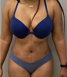 Tummy Tuck After Photo by Keshav Magge, MD; Bethesda, MD - Case 48065