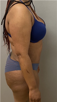 Tummy Tuck After Photo by Keshav Magge, MD; Bethesda, MD - Case 48065