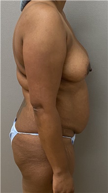 Tummy Tuck Before Photo by Keshav Magge, MD; Bethesda, MD - Case 48065