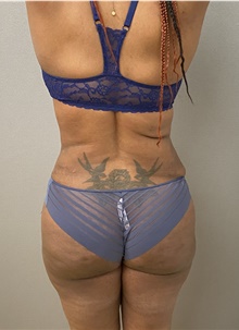 Buttock Lift with Augmentation After Photo by Keshav Magge, MD; Bethesda, MD - Case 48066
