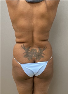 Buttock Lift with Augmentation Before Photo by Keshav Magge, MD; Bethesda, MD - Case 48066