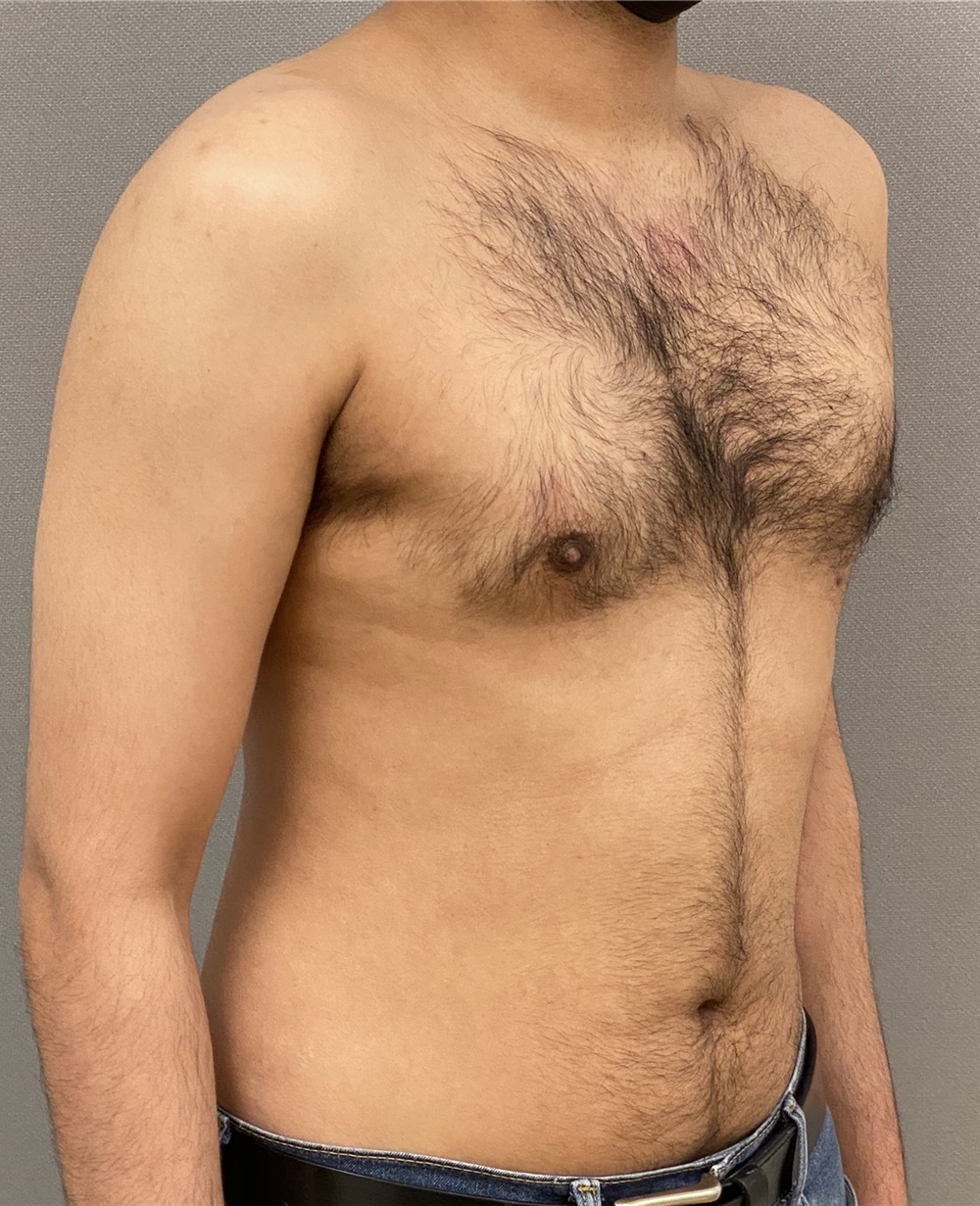 Male Breast Reduction Before and After Photos by Keshav Magge, MD; Bethesda,  MD - Case 48068