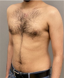 Male Breast Reduction After Photo by Keshav Magge, MD; Bethesda, MD - Case 48068