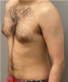 Male Breast Reduction Before Photo by Keshav Magge, MD; Bethesda, MD - Case 48068