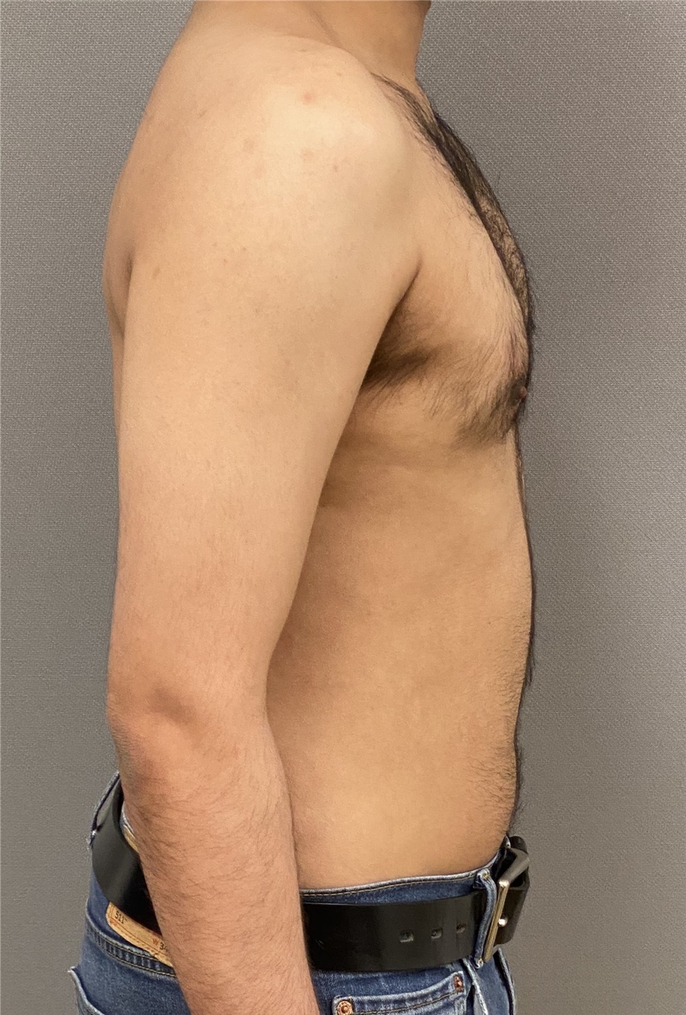 Male Breast Reduction Before and After Photos by Keshav Magge, MD; Bethesda,  MD - Case 48068