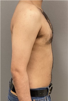 Male Breast Reduction After Photo by Keshav Magge, MD; Bethesda, MD - Case 48068