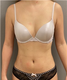 Liposuction After Photo by Keshav Magge, MD; Bethesda, MD - Case 48070