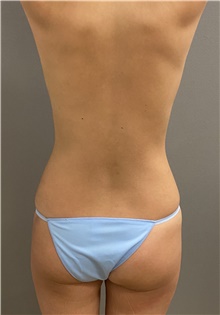 Liposuction Before Photo by Keshav Magge, MD; Bethesda, MD - Case 48070