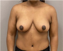 Breast Lift After Photo by Keshav Magge, MD; Bethesda, MD - Case 48127