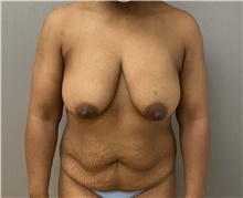 Breast Lift Before Photo by Keshav Magge, MD; Bethesda, MD - Case 48127