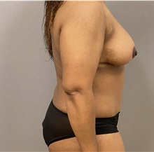 Breast Lift After Photo by Keshav Magge, MD; Bethesda, MD - Case 48127