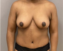 Tummy Tuck After Photo by Keshav Magge, MD; Bethesda, MD - Case 48128