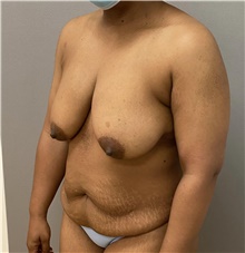 Tummy Tuck Before Photo by Keshav Magge, MD; Bethesda, MD - Case 48128
