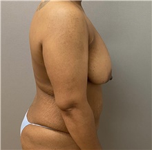 Tummy Tuck Before Photo by Keshav Magge, MD; Bethesda, MD - Case 48128