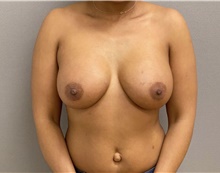Breast Augmentation After Photo by Keshav Magge, MD; Bethesda, MD - Case 48130