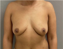 Breast Augmentation Before Photo by Keshav Magge, MD; Bethesda, MD - Case 48130
