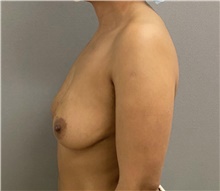 Breast Augmentation Before Photo by Keshav Magge, MD; Bethesda, MD - Case 48130