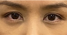 Eyelid Surgery After Photo by Keshav Magge, MD; Bethesda, MD - Case 48131