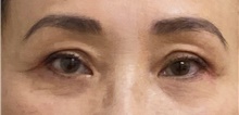 Eyelid Surgery After Photo by Keshav Magge, MD; Bethesda, MD - Case 48132
