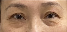 Eyelid Surgery Before Photo by Keshav Magge, MD; Bethesda, MD - Case 48132